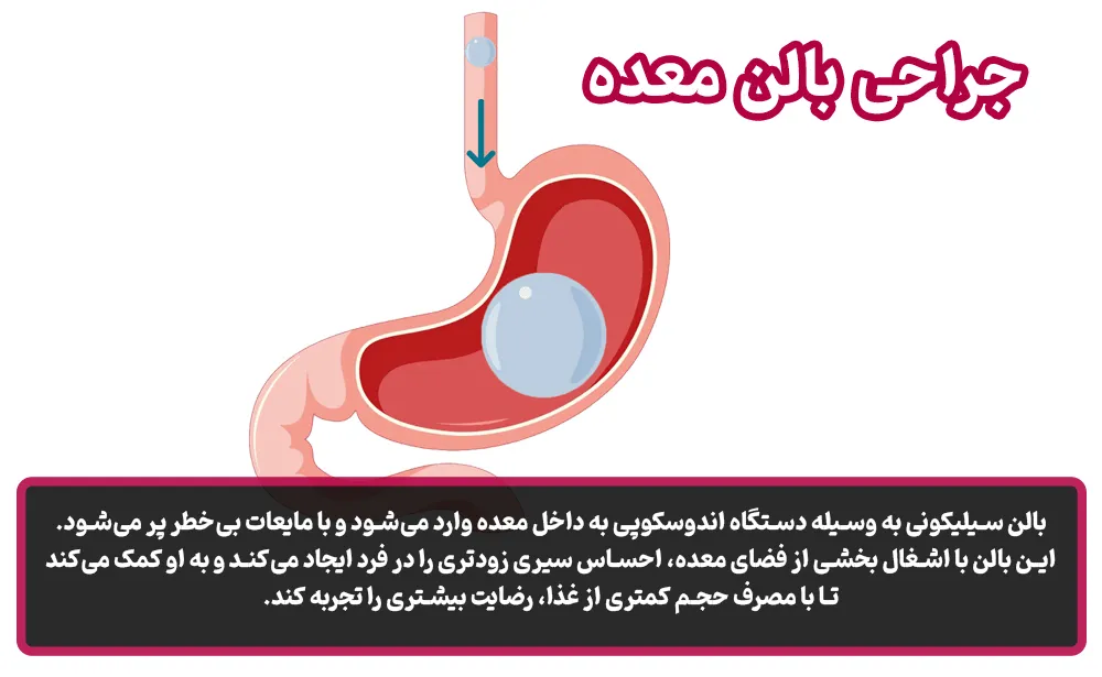 جراحی بالن معده