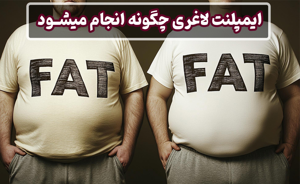 ایمپلنت لاغری چگونه انجام میشود