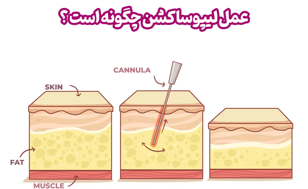 عمل لیپوساکشن چگونه است ؟