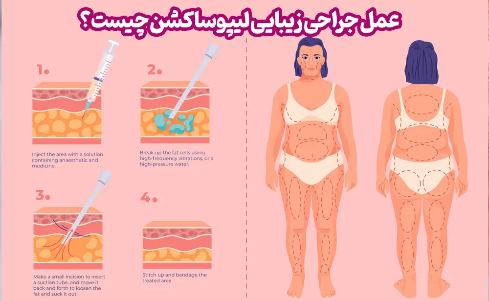عمل جراحی زیبایی لیپوساکشن چیست