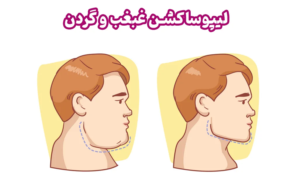 لیپوساکشن غبغب و گردن