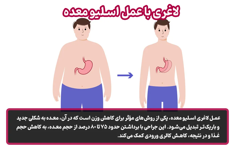 لاغری با عمل اسلیو معده
