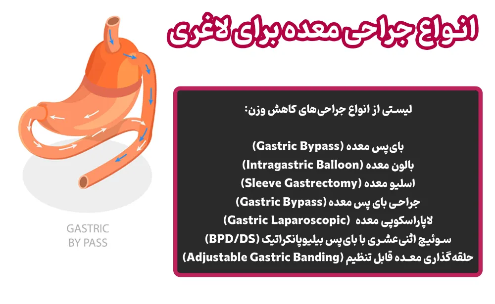 انواع جراحی معده برای لاغری