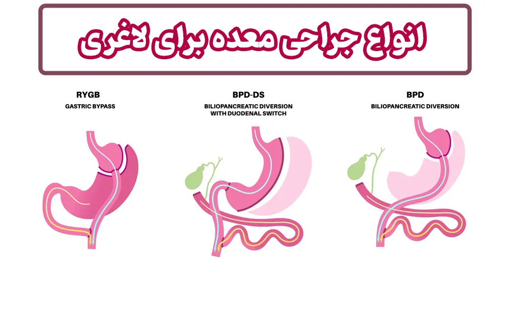 انواع جراحی معده برای لاغری