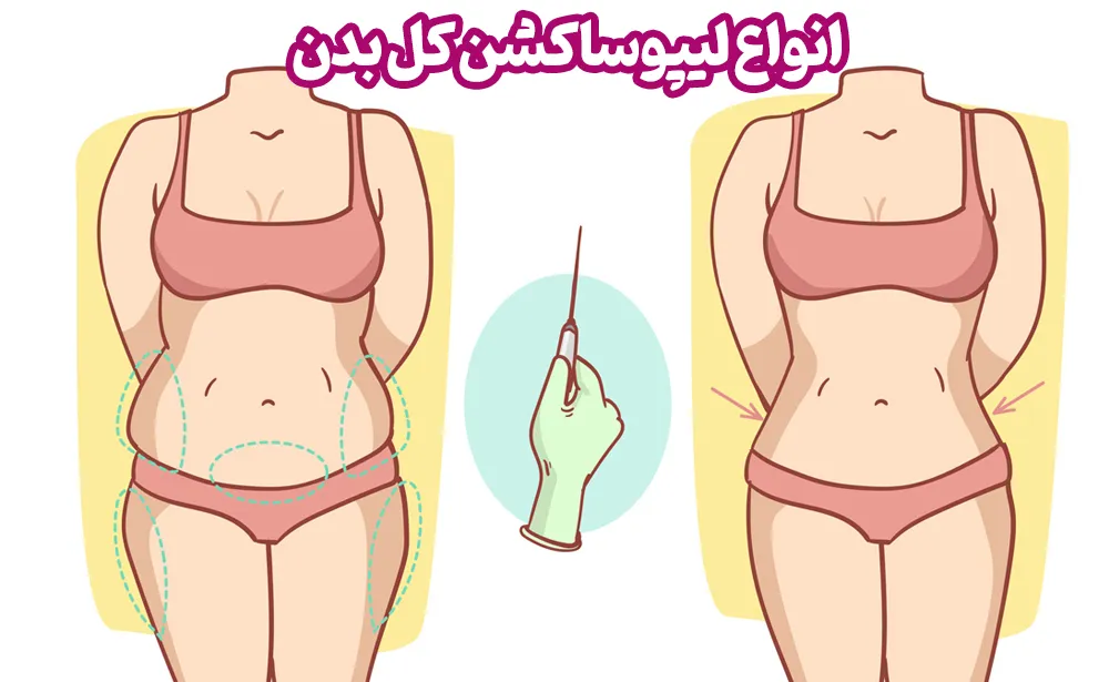 انواع لیپوساکشن کل بدن