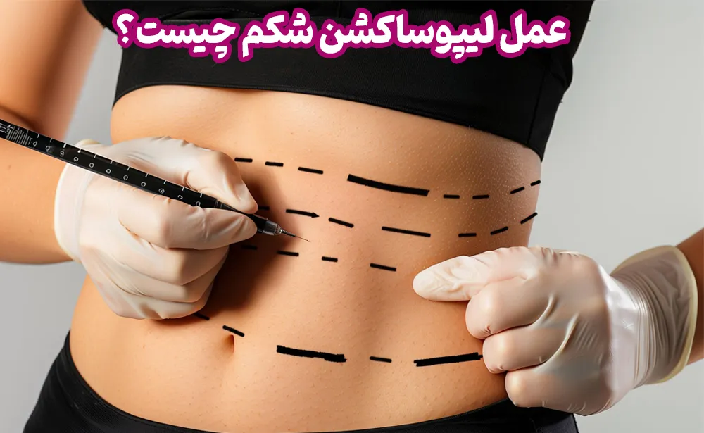 لیپوساکشن شکم