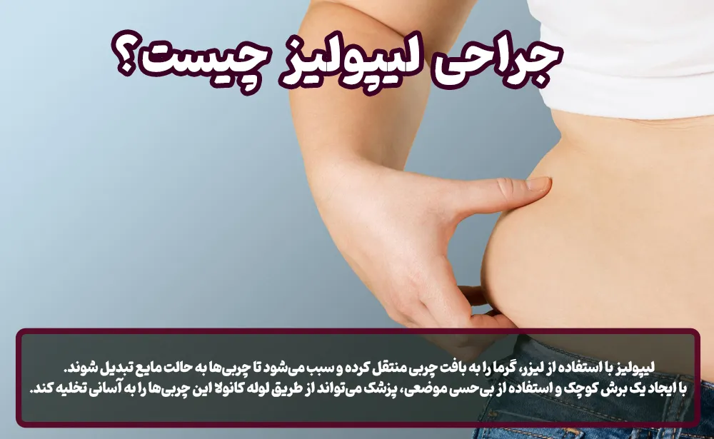 جراحی لیپولیز چیست ؟