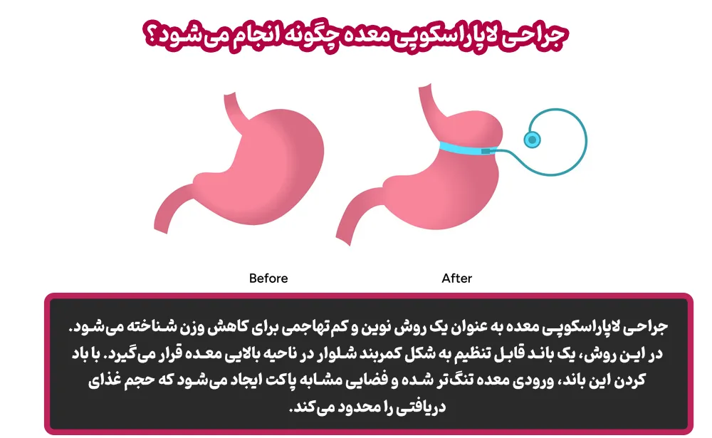 عمل لاپاراسکوپی معده چیست