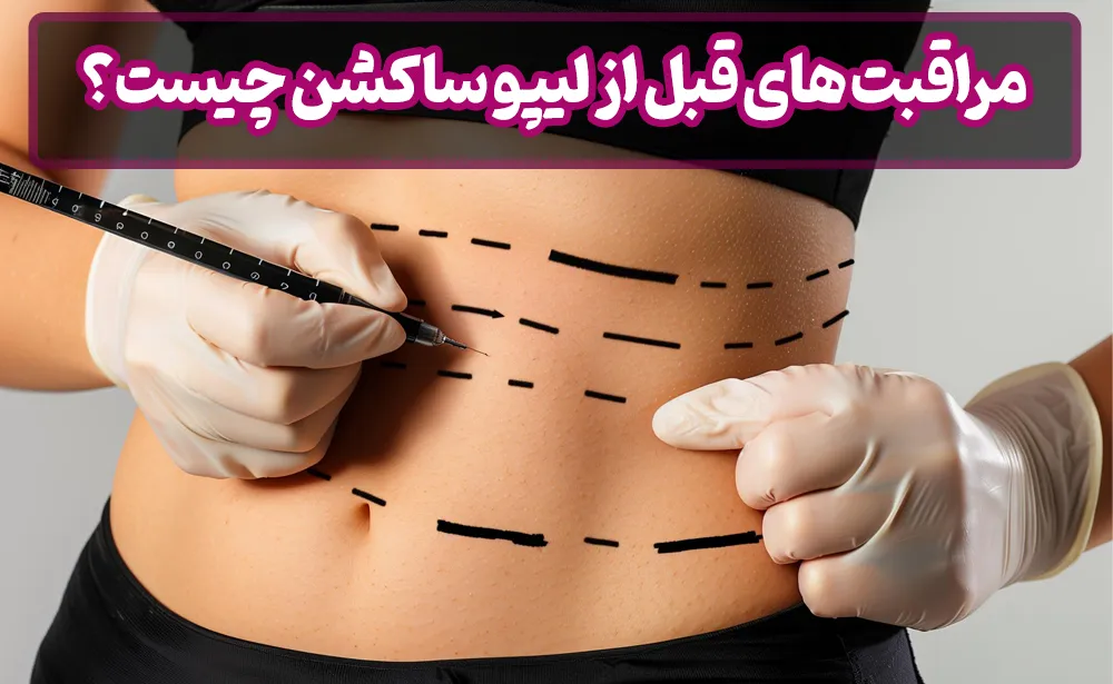 مراقبت های قبل از لیپو ساکشن چیست؟